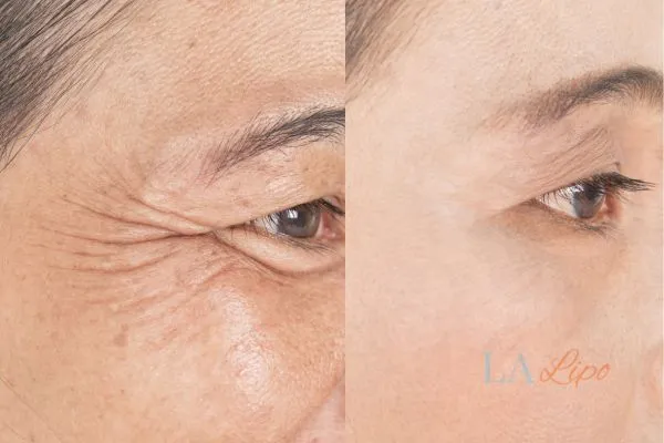 Before and after results of woman - HI-fu wrinkles reduction treatment Bishop Auckland