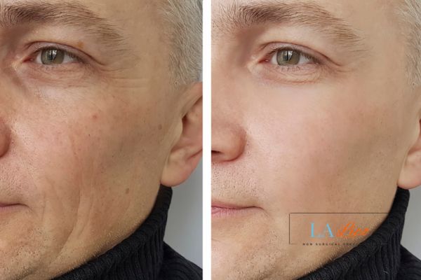 See the amazing results of Morpheus8 Treatment Bishop Auckland!